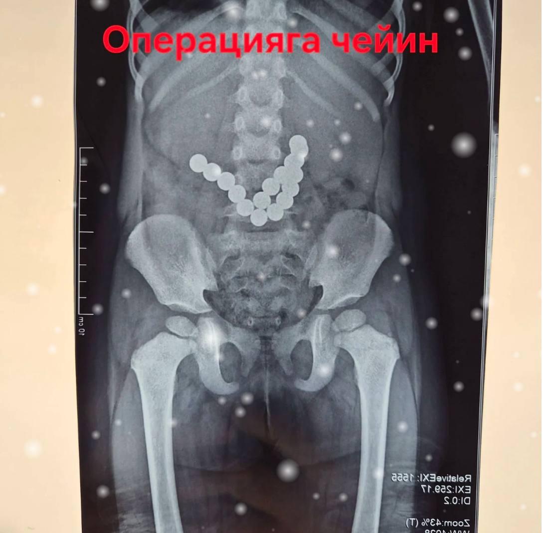 Ошто 2 жашар баланын ичегисинен 17 даана магнит чыгарылды